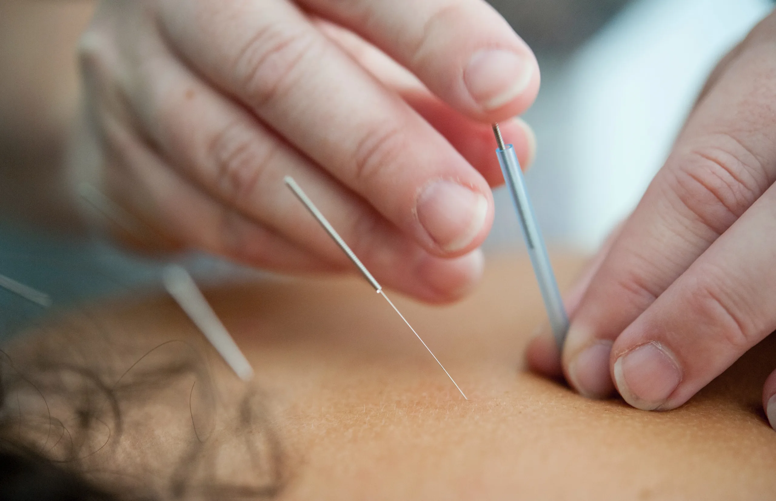 Acupuntura en espalda