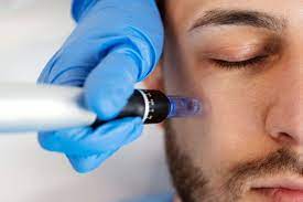 Dermapen para hombres