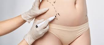 Mesoterapia-Abdomen-Resultados