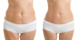 Mesoterapia-Reductora-Abdomen-y-Cintura