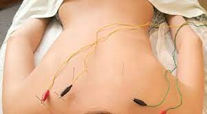 ElectroAcupuntura en espalda de mujer
