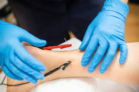 ElectroAcupuntura en Piernas